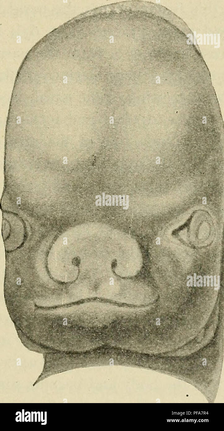 . El desarrollo del cuerpo humano : un manual de embriología humana. Embriología; Embrión, Non-Mammalian. El desarrollo de la cara 99 La región inmediatamente delante del primer arco está ocupado por una profunda depresión, sino la fosa oral, cuyo desarrollo temprano ya se ha notado. En el embrión mide 8 mm. de longitud (Fig. 62) la fosa (os) ha asumido una cierta forma de cuadrilátero irregular. Su límite posterior está formado por los procesos mandibular del primer arco, mientras que lateralmente está limitada por los procesos maxilares (MXP) y delate por el borde libre de una placa mediana, te Foto de stock