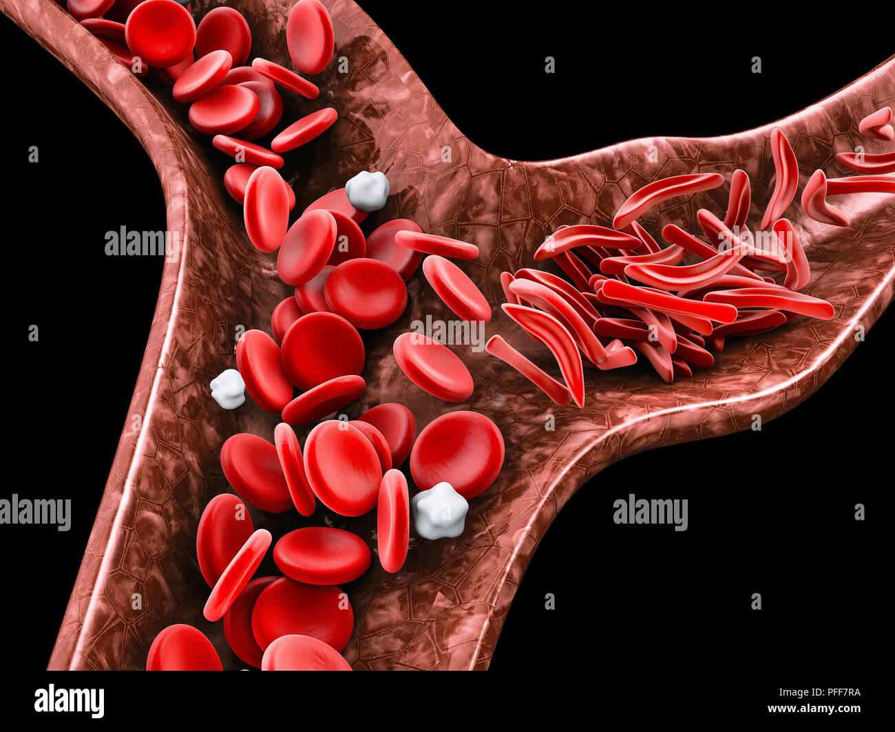 La anemia de células falciformes, 3D ilustración mostrando vasos sanguíneos con normalidad y deformadas crescent Foto de stock