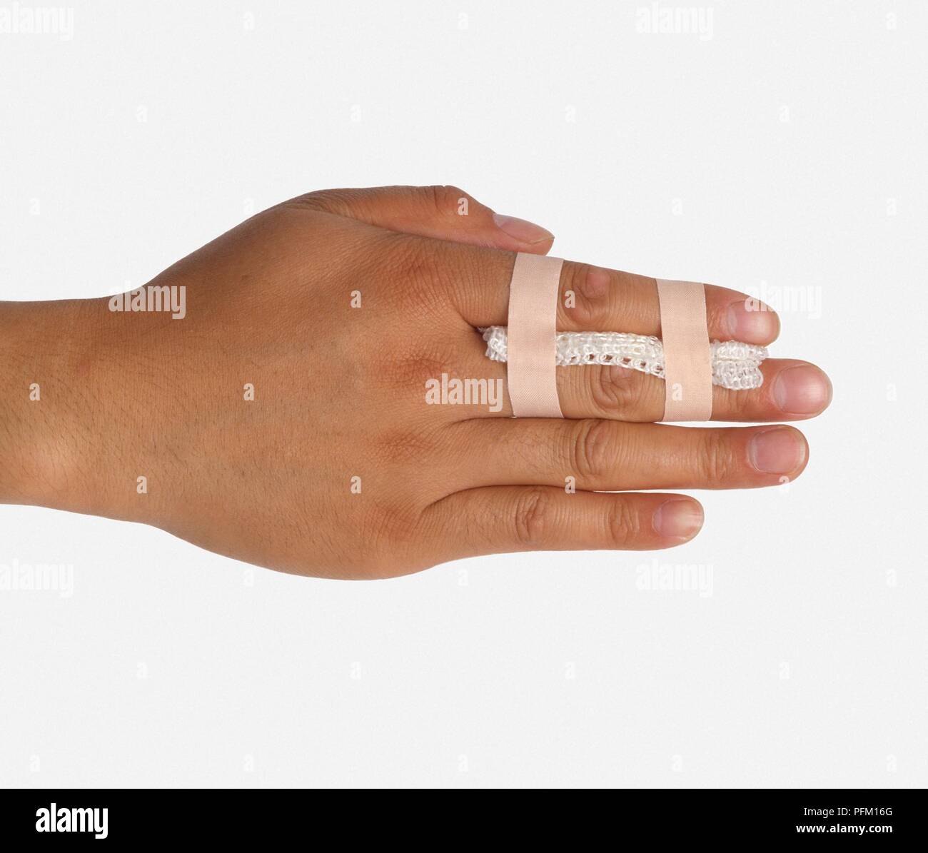 Dedo fracturado pegados a los dedos adyacentes, una técnica llamada