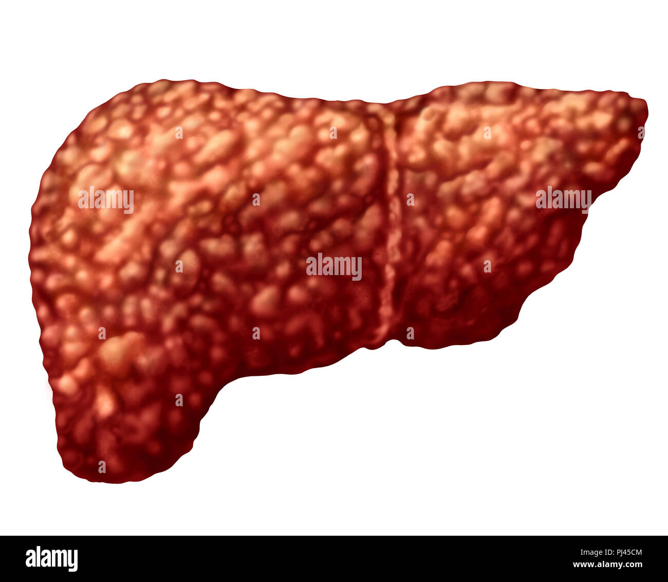 Hígado graso o esteatosis hepática parte del cuerpo aislado en blanco como un concepto médico de atención de salud del sistema digestivo Anatomía y órgano vital. Foto de stock