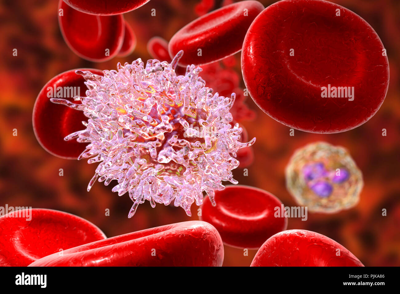 Leucemia de células pilosas. Ilustración del equipo anormal de glóbulos  blancos (linfocitos B-) de un paciente con leucemia de células pilosas.  Estas células muestran característico pelo-como proyecciones  citoplasmáticas y volantes en sus