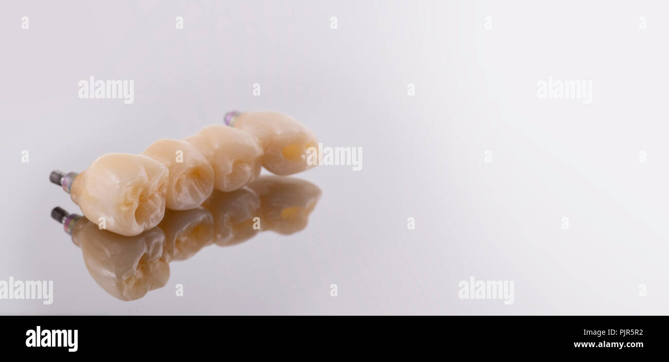 Diente implante humano. Concepto Dental. Los dientes humanos de