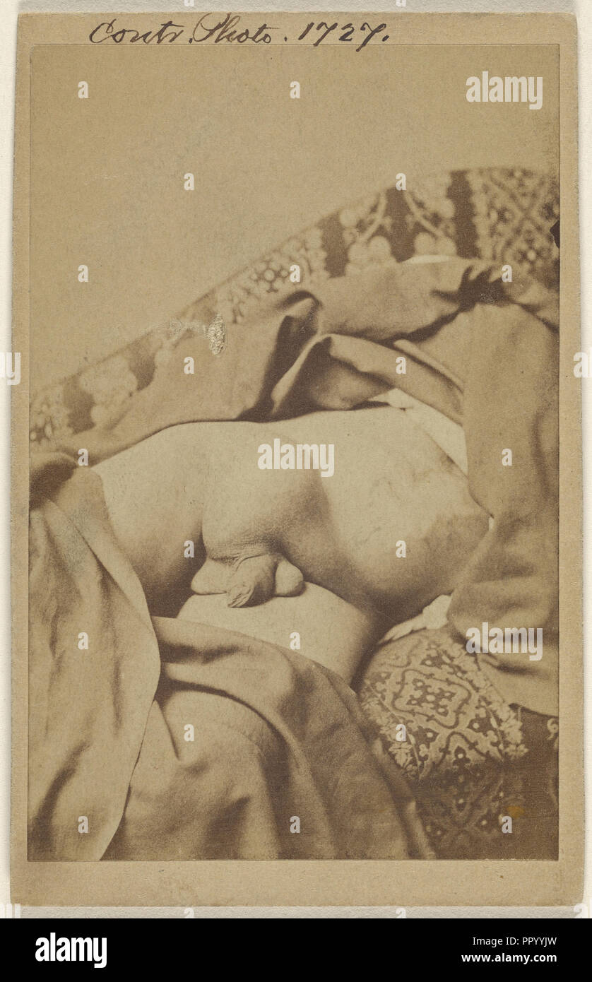 Los testículos no descendidos con Hydwelle enfermas; American; 1862 - 1872; Albúmina imprimir plata Foto de stock