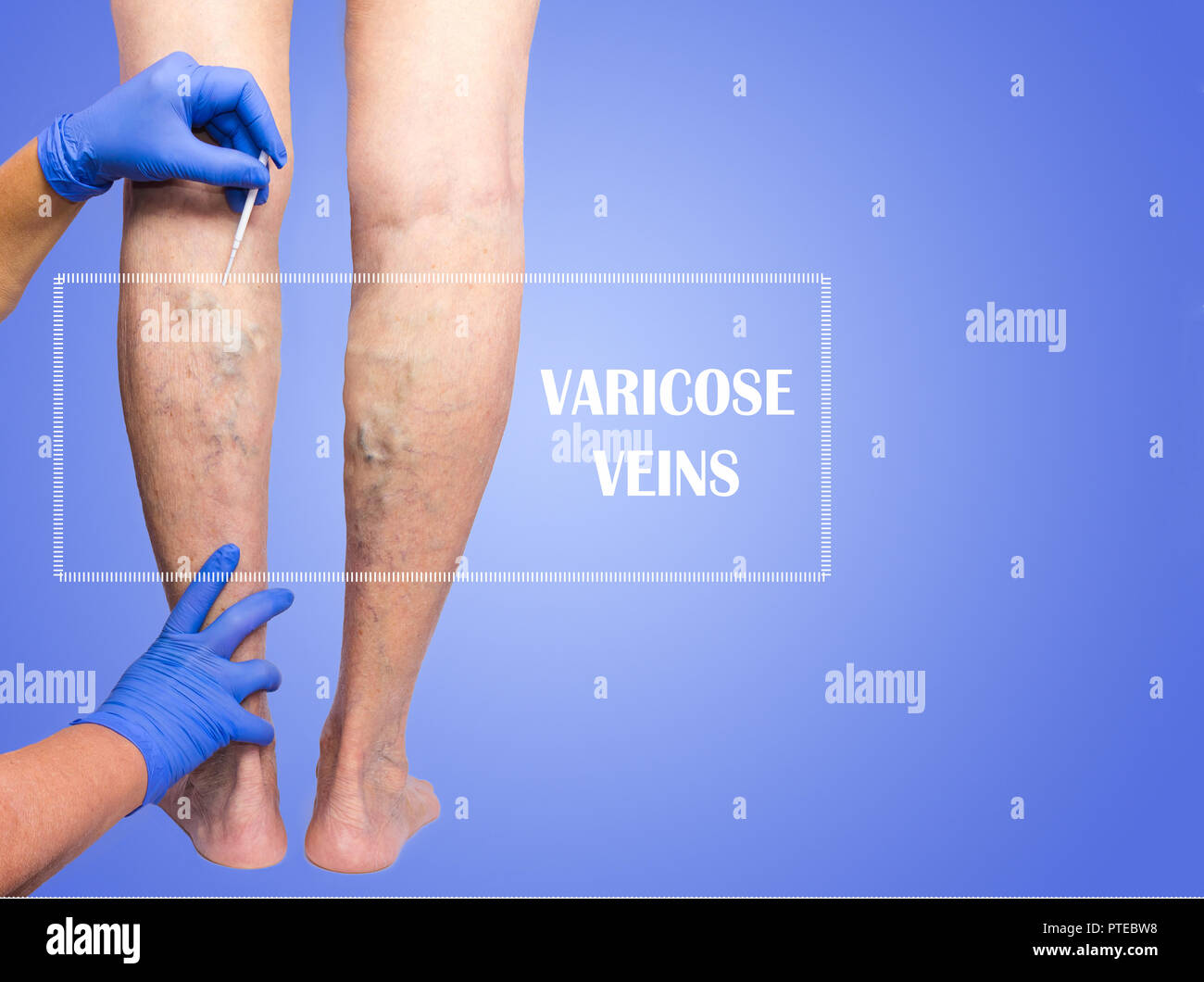 Examen vascular de la extremidad inferior porque sospecha de insuficiencia venosa. Foto de stock