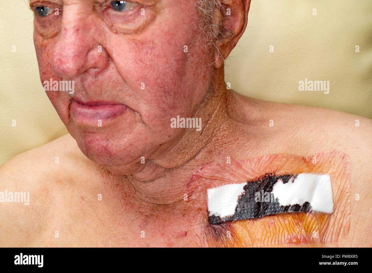 Hombre recuperándose después de haber instalado un marcapasos. Foto de stock