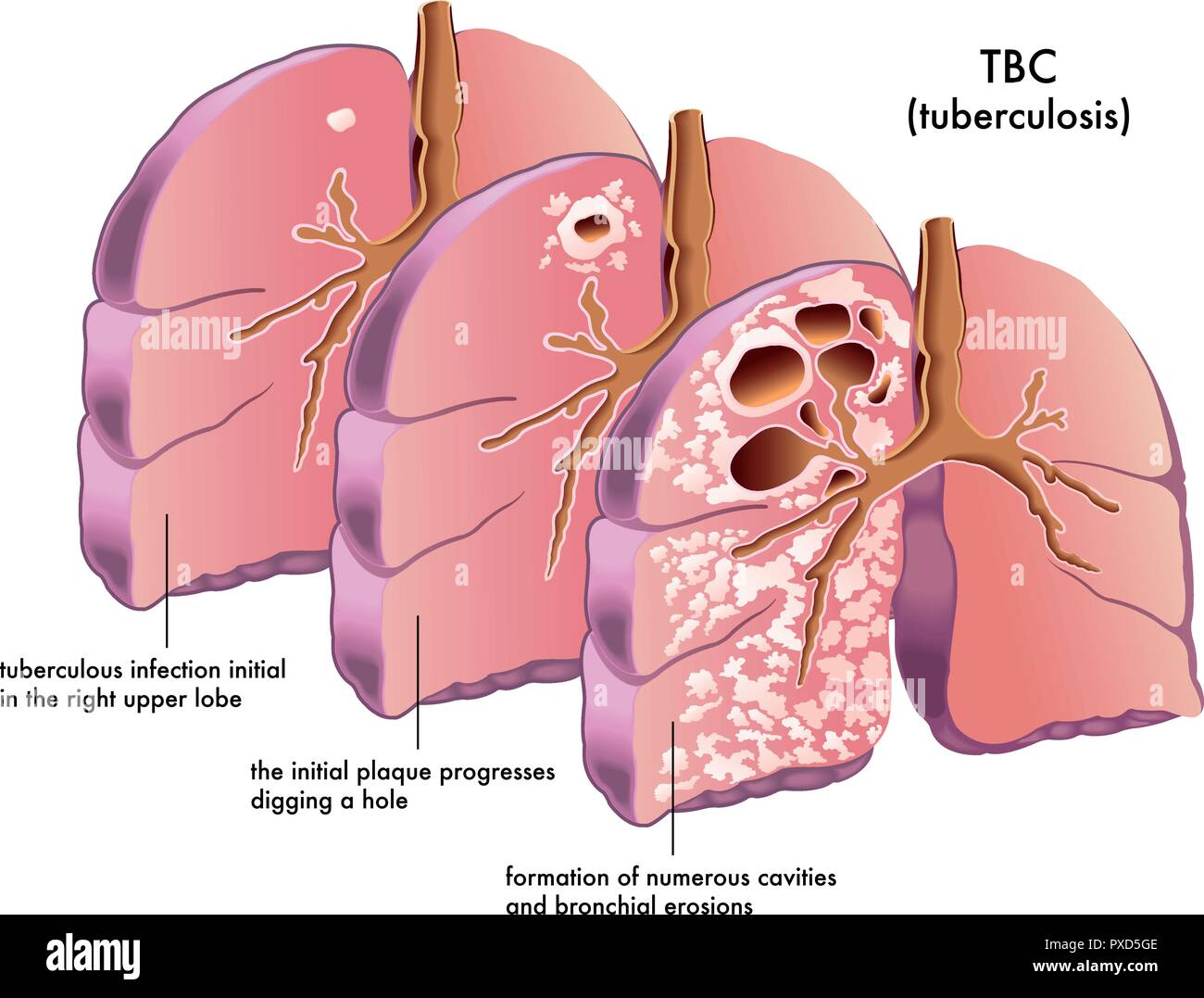 Vector ilustración médica de los síntomas de la tuberculosis Ilustración del Vector