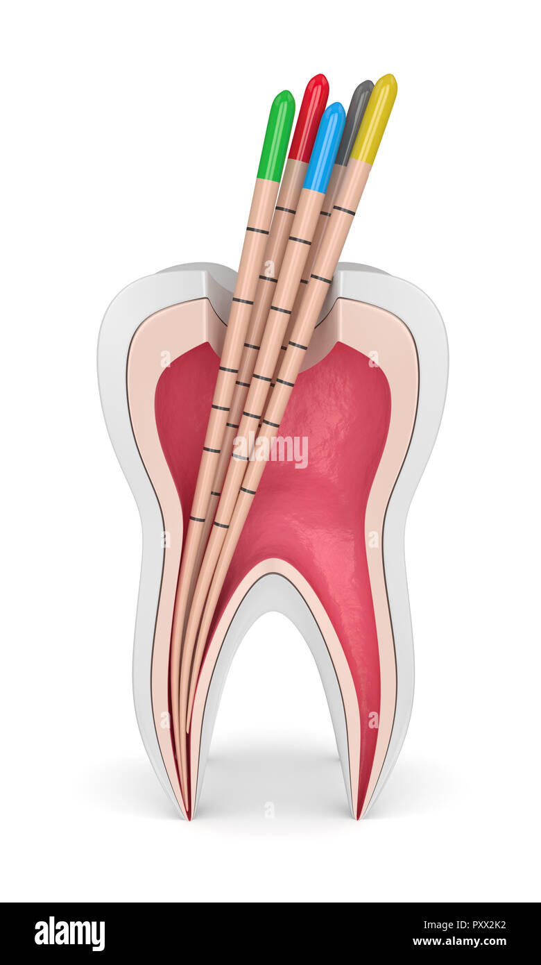 3D Render de diente con gutapercha