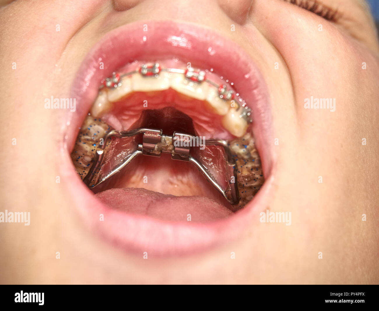 Boca con tirantes de retención para los dientes. La ortodoncia Dental  métodos tema de dientes (mordida) Corrección. Hyrax y servidumbre aparatos  de expansión Fotografía de stock - Alamy