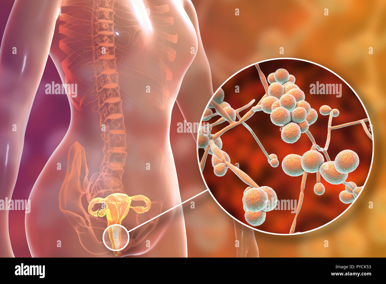 La infección de Candida albicans en la hembra. Equipo ilustración