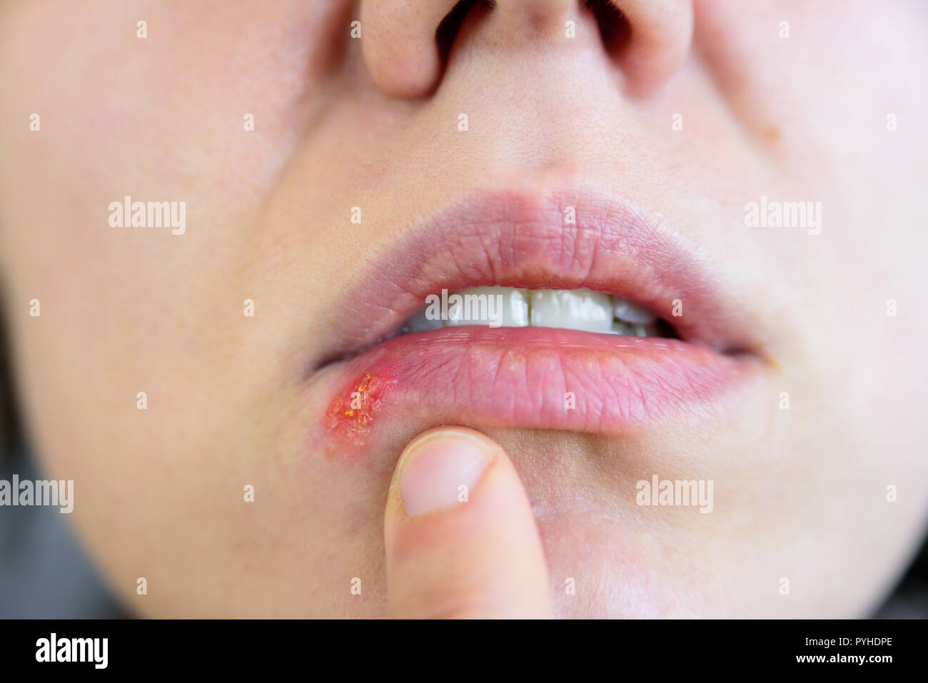 Mujer joven tocando su herpes labial. El dolor, las emociones. Cerrar  Fotografía de stock - Alamy