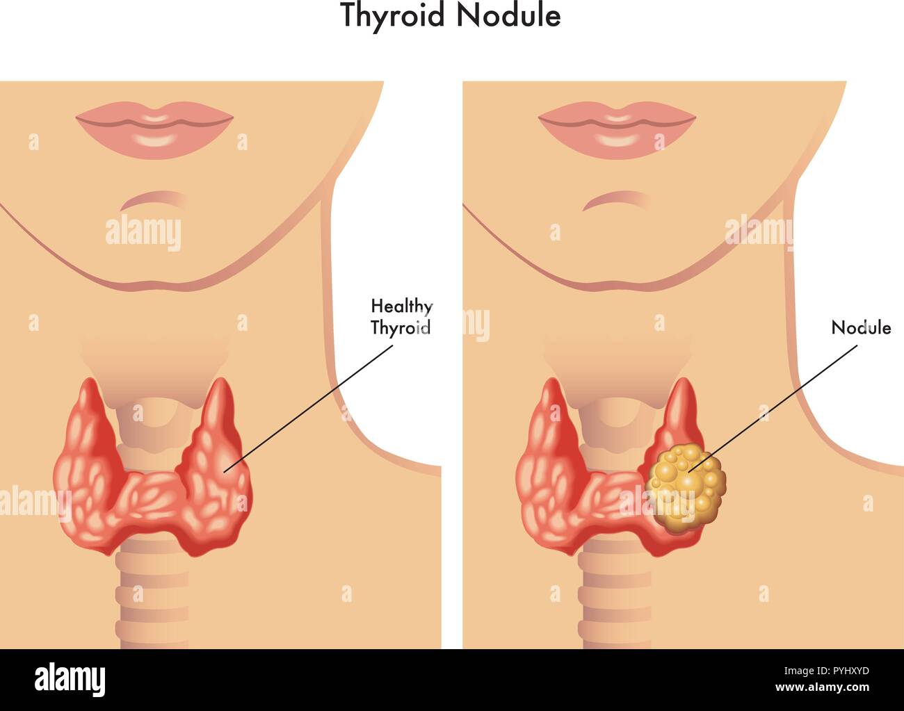 Ilustración médica de los síntomas del nódulo tiroideo Ilustración del Vector