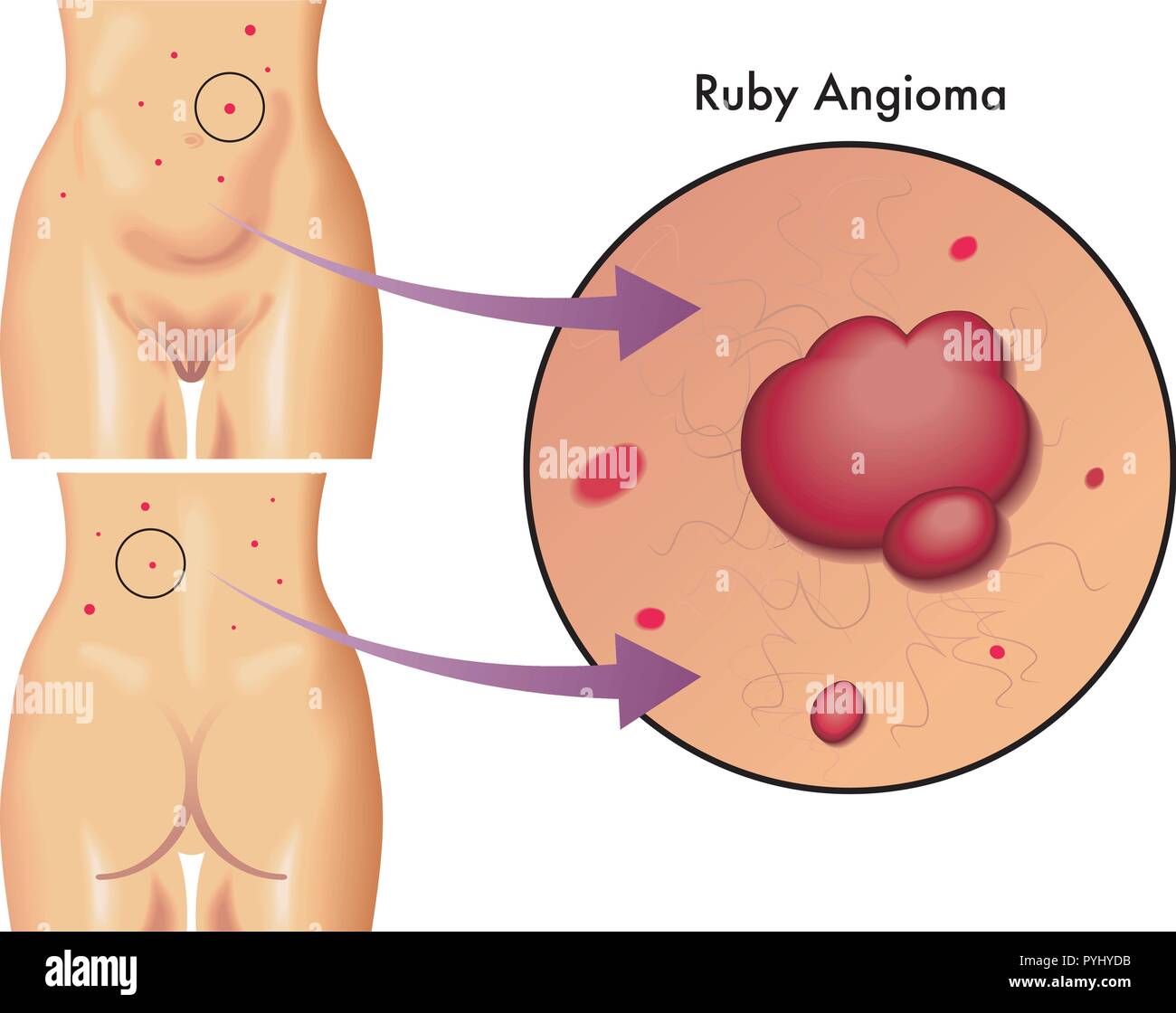 Vector ilustración médica de los síntomas del angioma ruby Ilustración del Vector