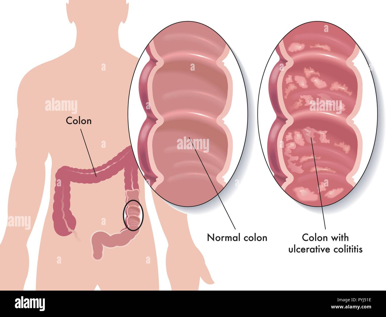 Ilustración médica de los efectos de la colitis ulcerosa Ilustración del Vector
