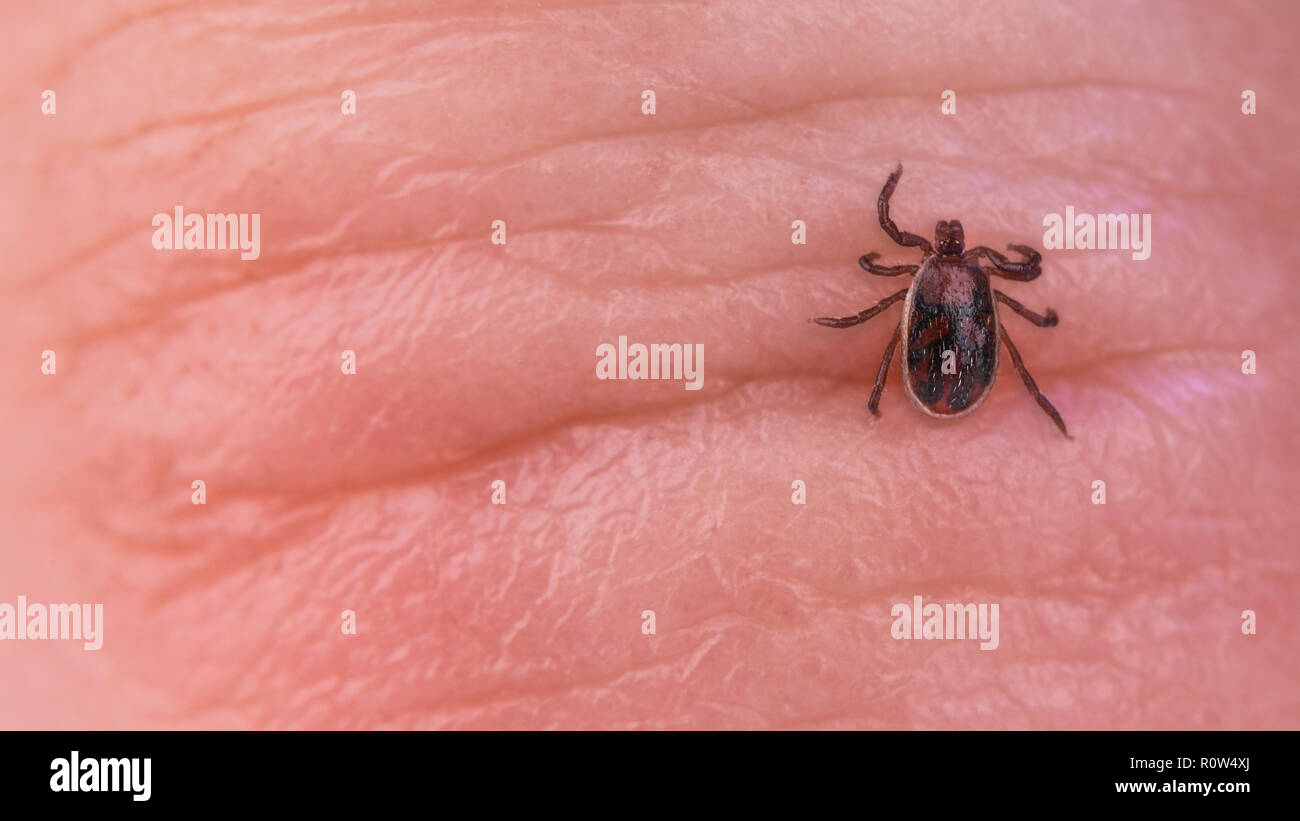 Garrapata del perro marrón parásito. Cerca de la piel. Rhipicephalus sanguineus. Ixodida. Ácaro infectados sobre arrugado dedo humano detalle. Las enfermedades transmitidas por las garrapatas portador. Foto de stock