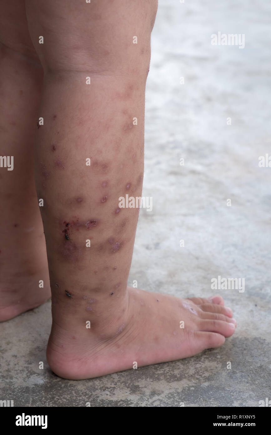 Dermatitis atópica picor del pie del bebé. Cerrar herida infectada