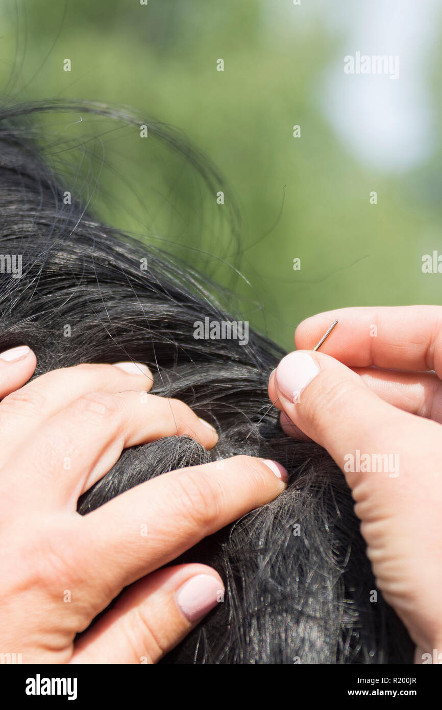 La acupuntura. Se inserta la aguja en la piel de un caballo. Alemania Foto de stock