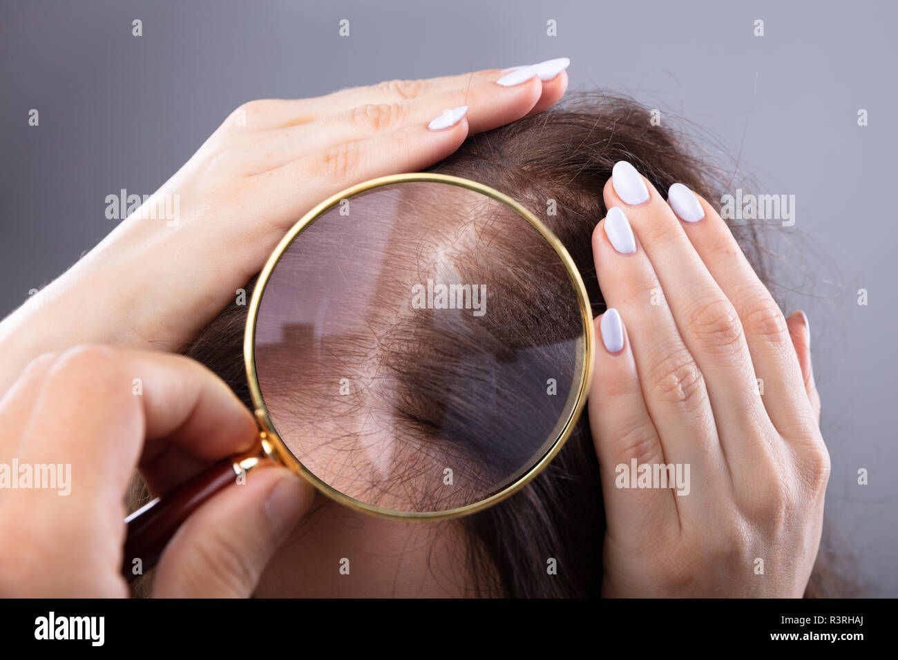 El dermatólogo Mano del cabello de la mujer examinar con lupa Foto de stock