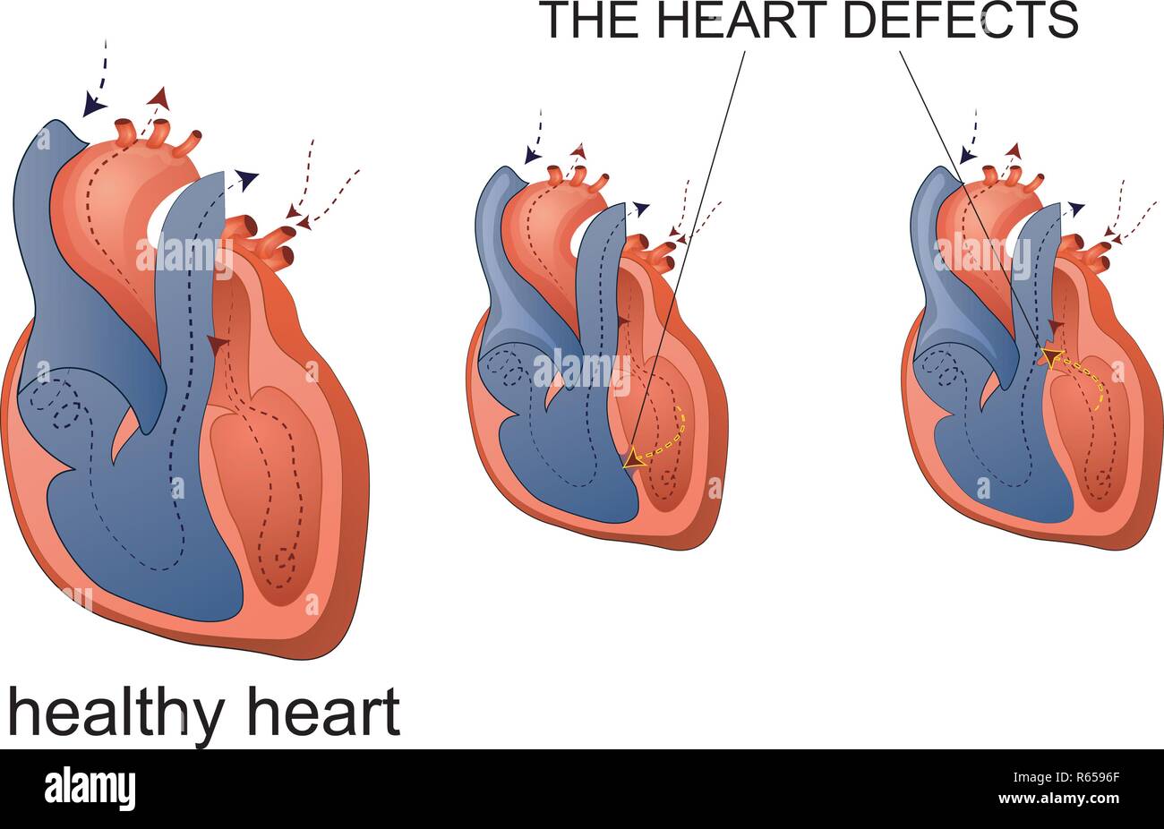 Enfermedad del corazón Imágenes vectoriales de stock - Alamy