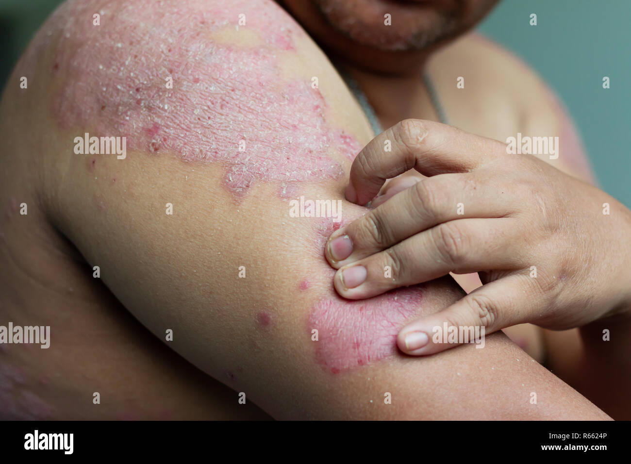 Los hombres usan sus manos para rascar la herida en sus brazos. Enfermedades  causadas por anormalidades de los ganglios. La psoriasis es una enfermedad  de la piel. Seleccione focus será Fotografía de