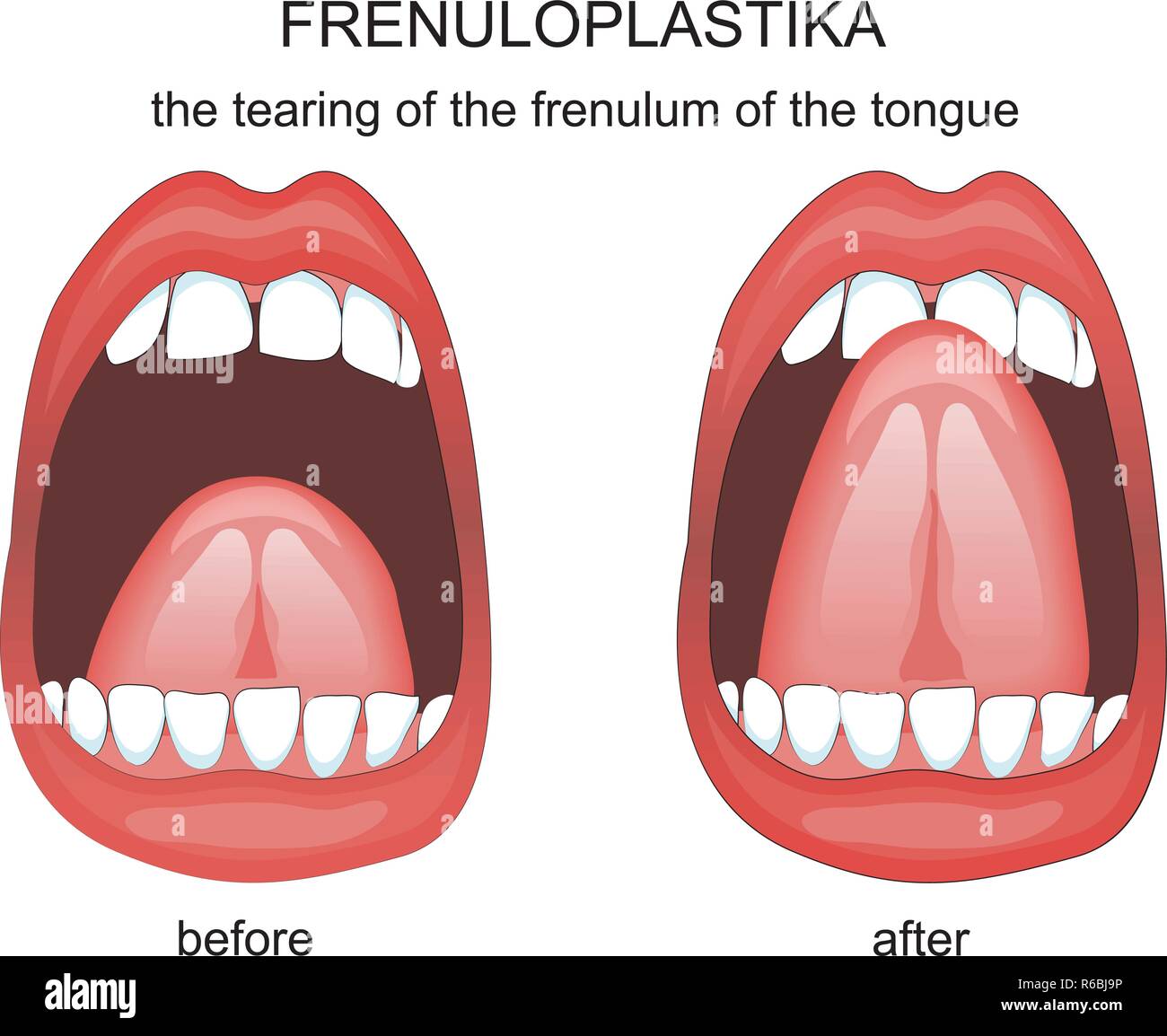 Ilustración de disección del frenillo de la lengua. frenuloplastika