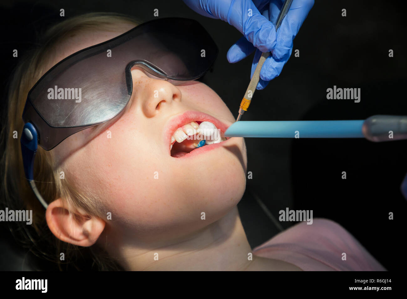 Aplicación de sellador de fisuras (gel azul, antes de endurecimiento con luz ultravioleta UV) para dientes que han sufrido a causa de la fluorosis / hypomineralisation de esmalte de diente. En el Reino Unido. (104) Foto de stock