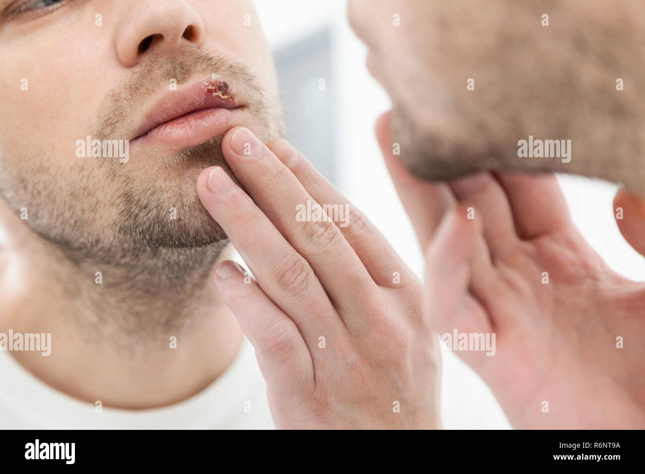 Joven Sufre De Herpes En La Boca Foto Imagen De Stock 227902790