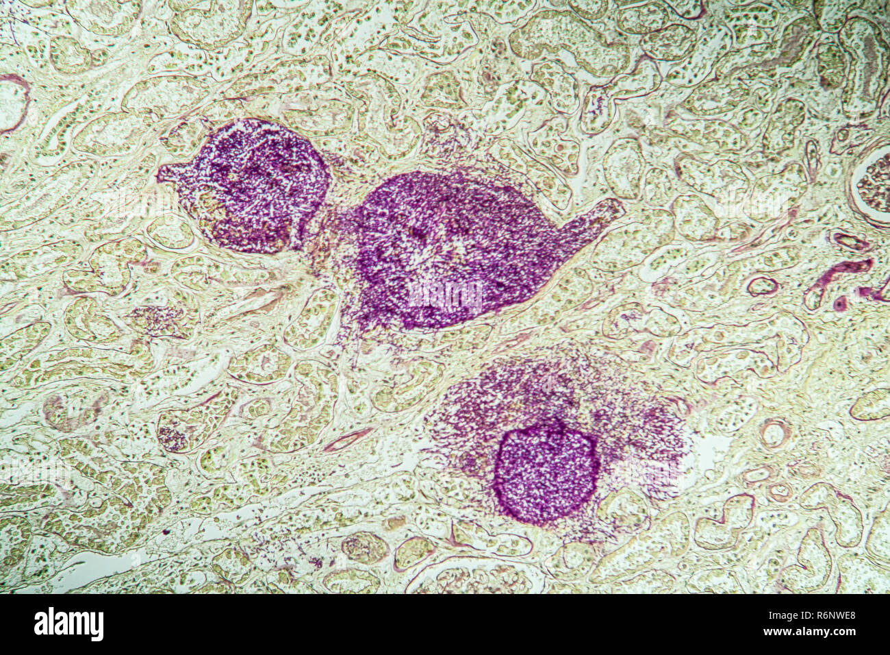 El riñón de un paciente con sida bajo el microscopio Fotografía de stock -  Alamy