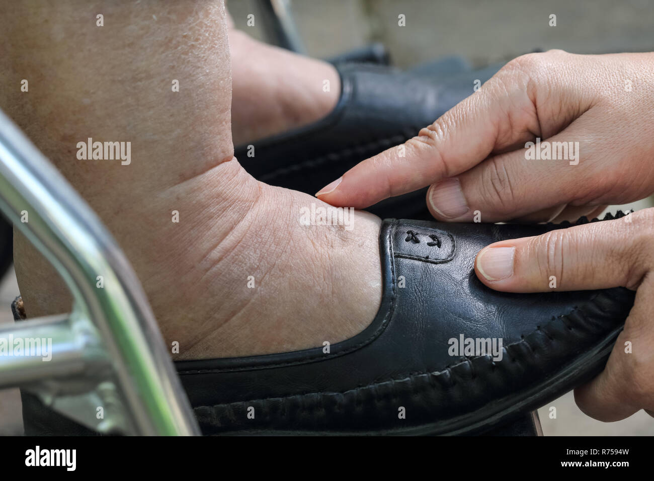 Anciana de pies hinchados pulse Prueba en silla de ruedas Fotografía de  stock - Alamy