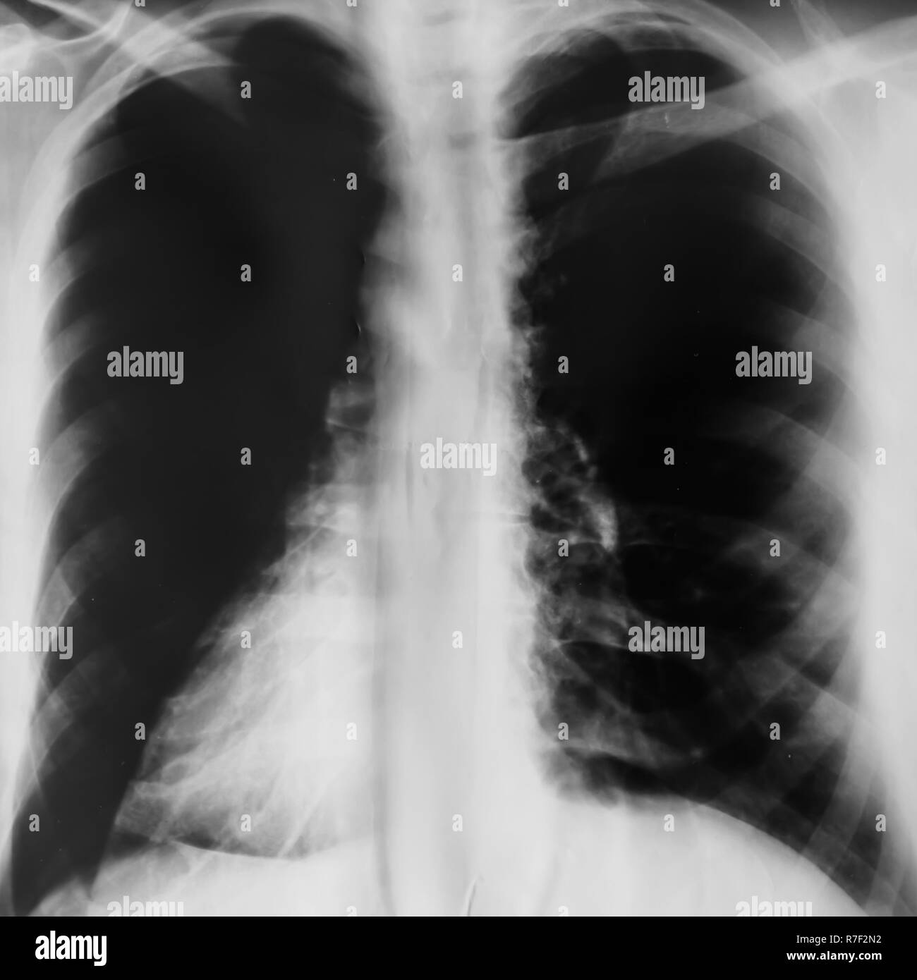Radiografía pulmonar, la película de rayos x o el examen de los pulmones Foto de stock