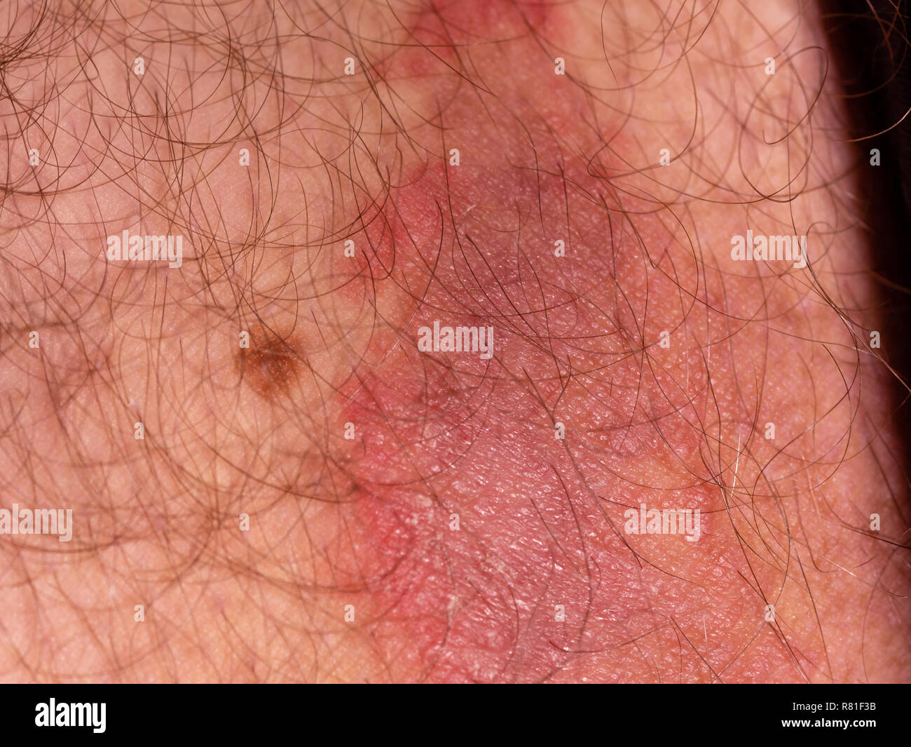 Infección micótica de la piel del muslo masculino Foto de stock