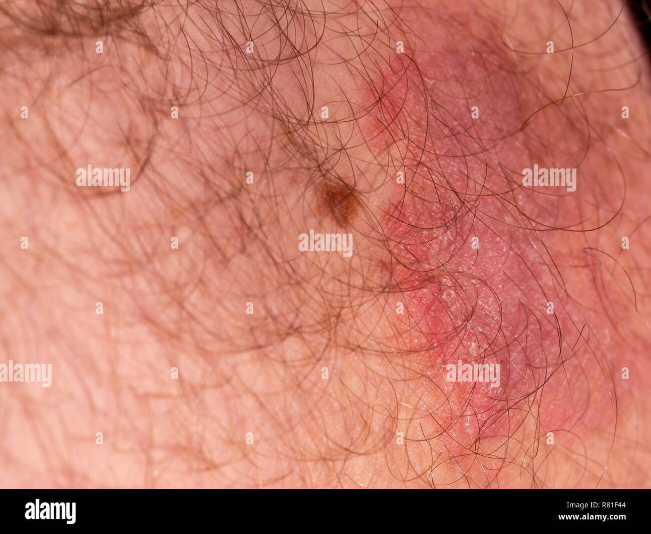 Infección micótica de la piel del muslo masculino Foto de stock