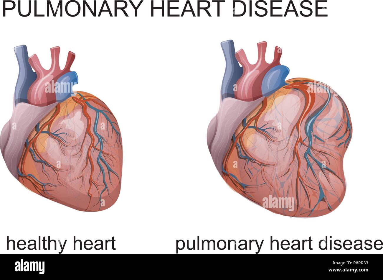 Enfermedad del corazón Imágenes vectoriales de stock - Alamy