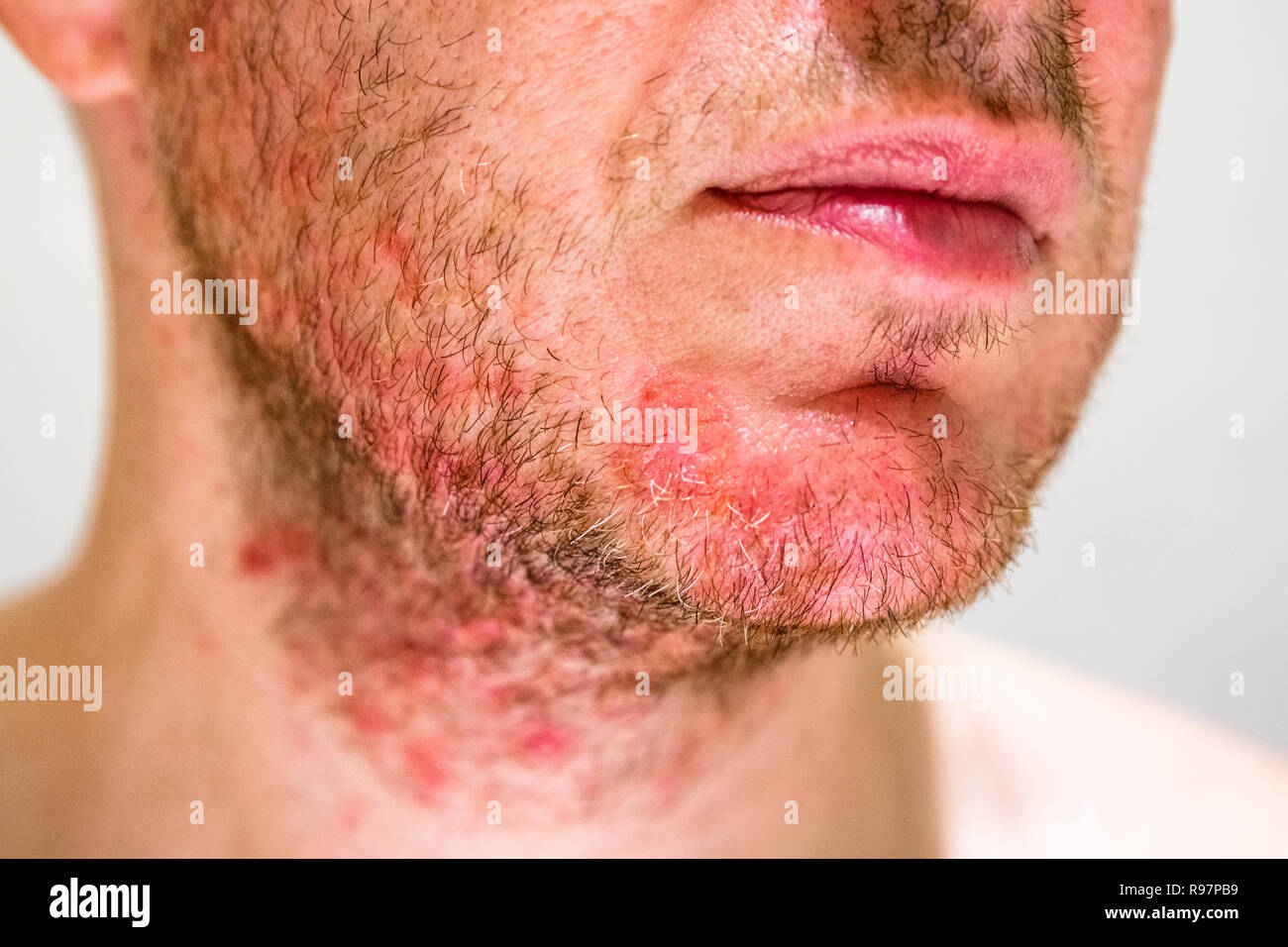 Hombre con dermatitis seborreica en la región de la barba Foto de stock