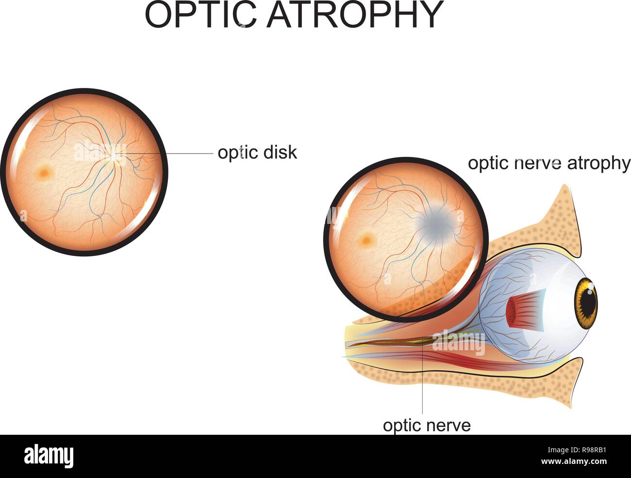 Atrofia del nervio optico fotografías e imágenes de alta resolución - Alamy