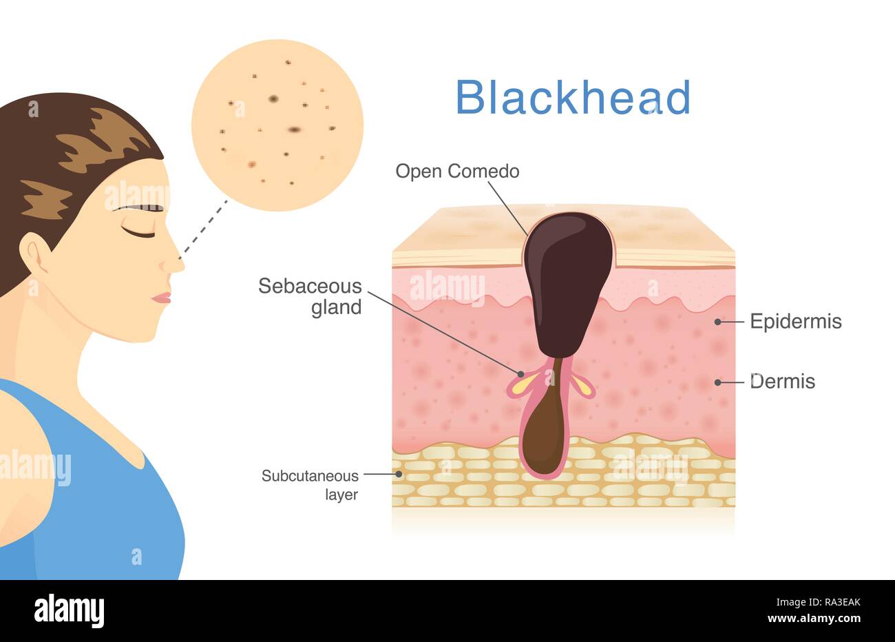 Como Quitar Espinillas Negras De La Nariz Poro obstruido fotografías e imágenes de alta resolución - Alamy