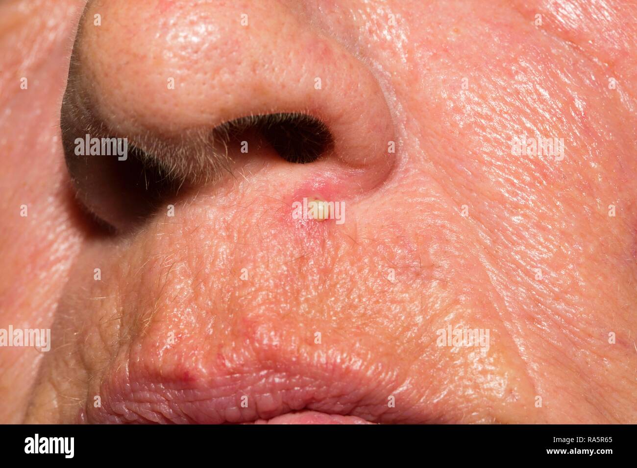 Nariz inflamada fotografías e imágenes de alta resolución - Alamy