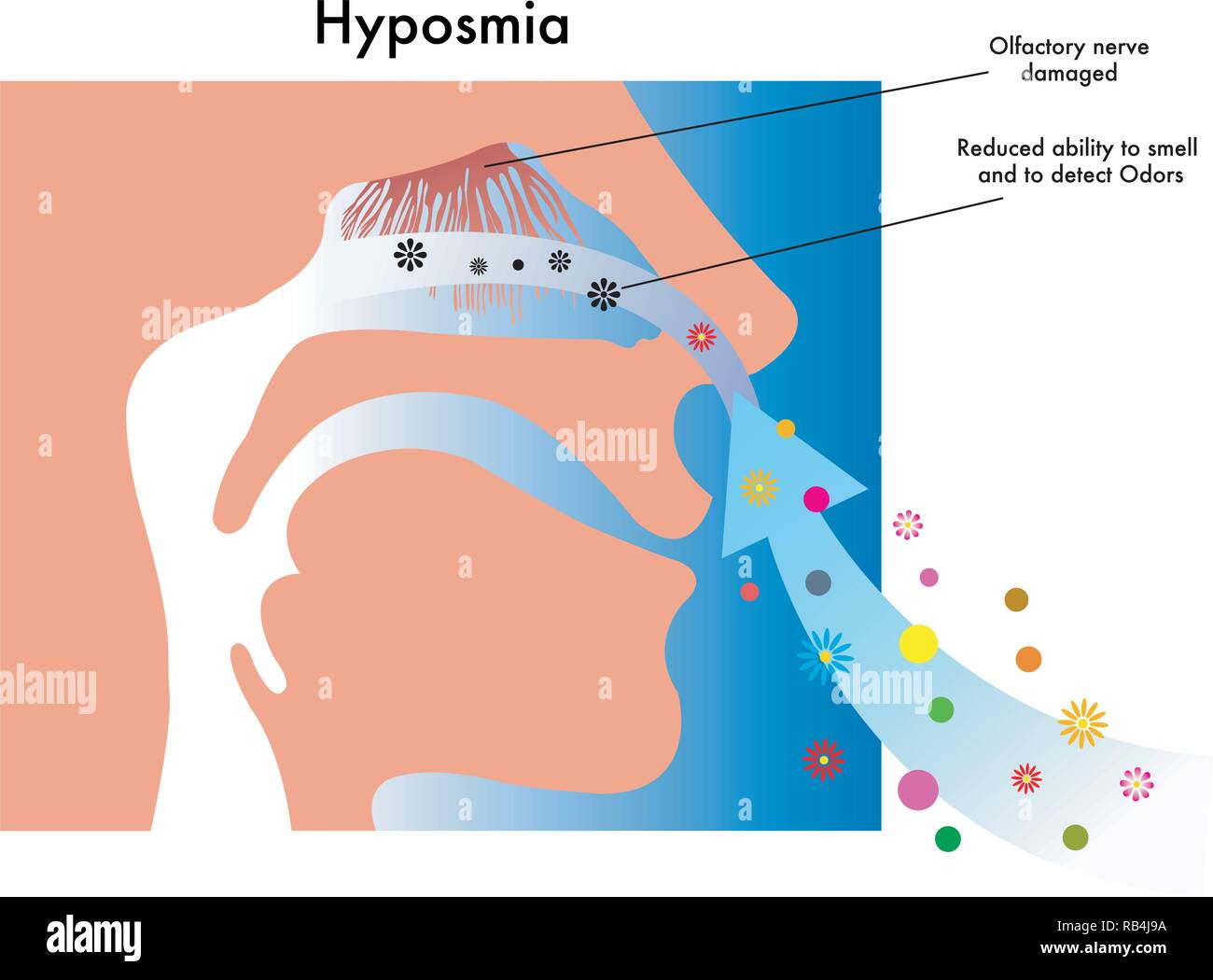 Ilustración médica simbólica de los síntomas de la hiposmia Ilustración del Vector
