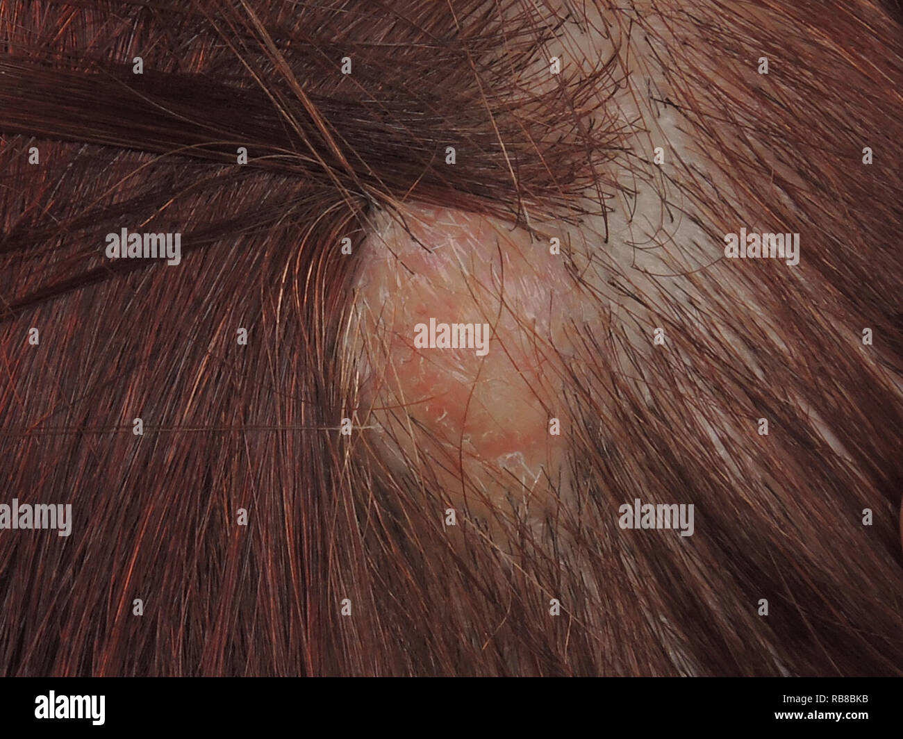 Quiste epidermoide fotografías e imágenes de alta resolución Alamy
