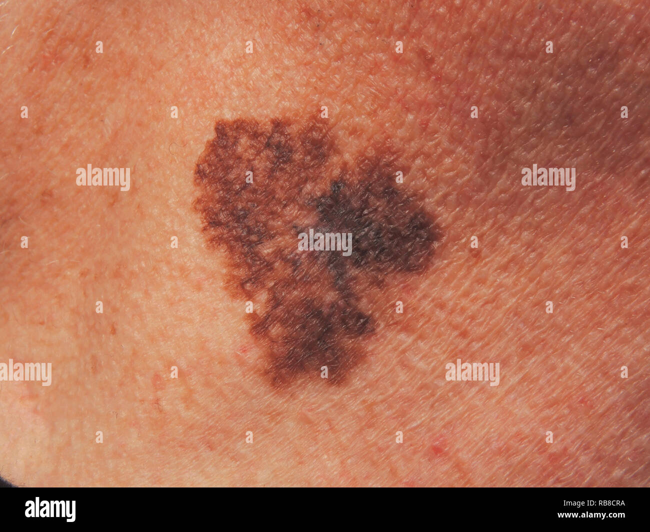 Lentigo Maligna Melanoma Fotografías E Imágenes De Alta Resolución Alamy