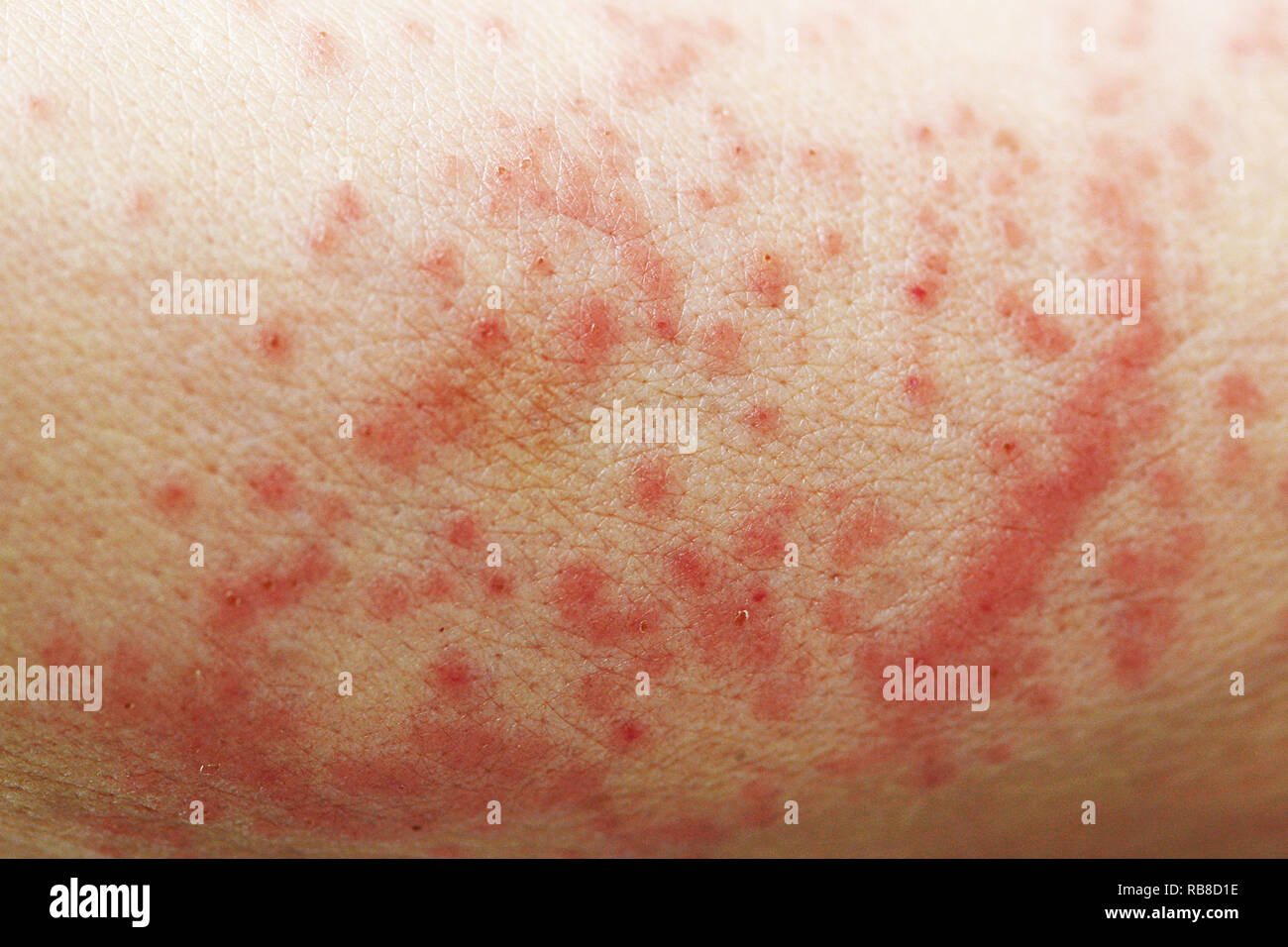 La dermatitis de contacto Fotografía de stock Alamy