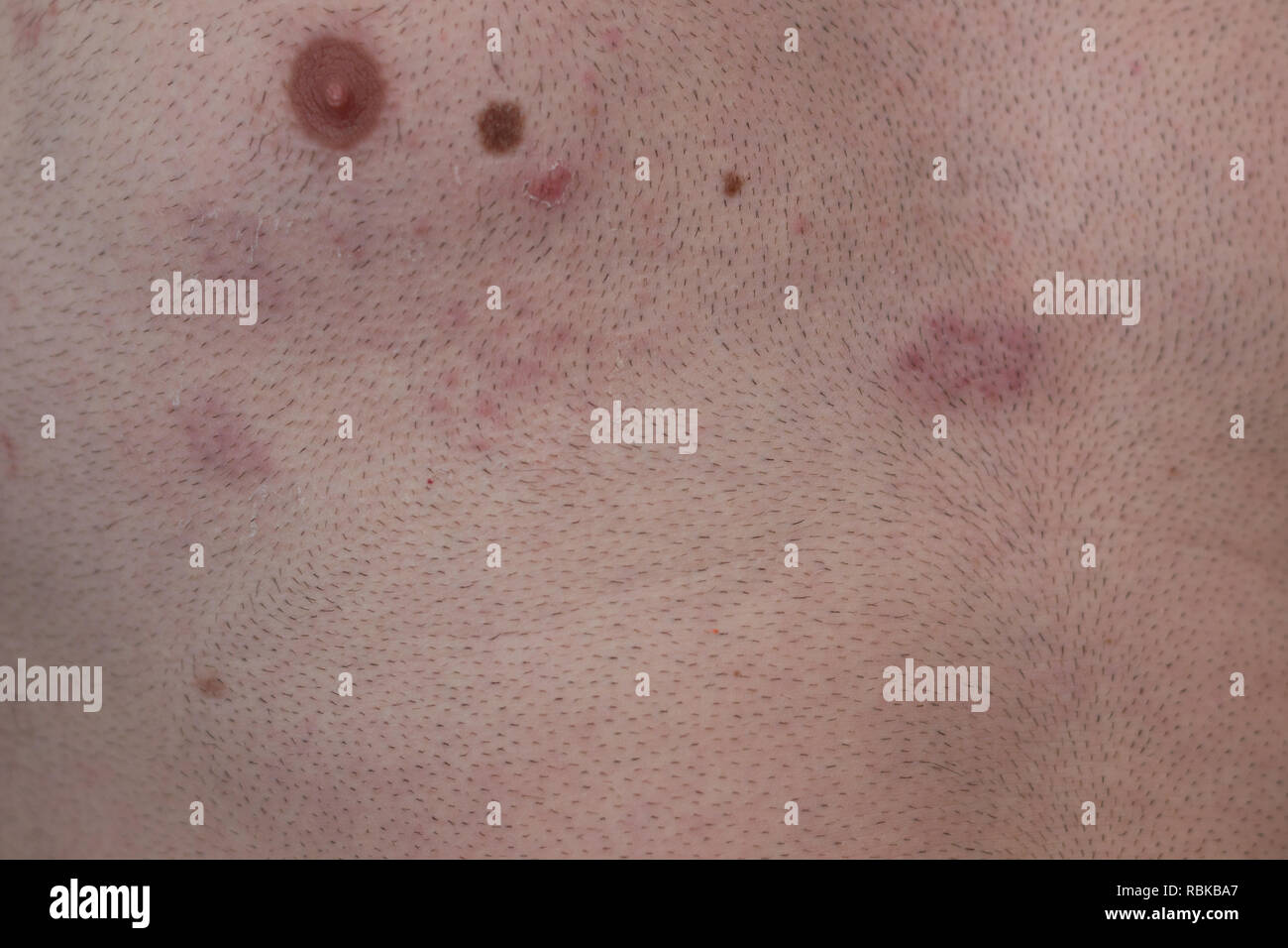 Enfermedad de culebrilla, herpes zoster, ampollas en el cuerpo, el virus  varicela-zoster, erupción en la piel Fotografía de stock - Alamy