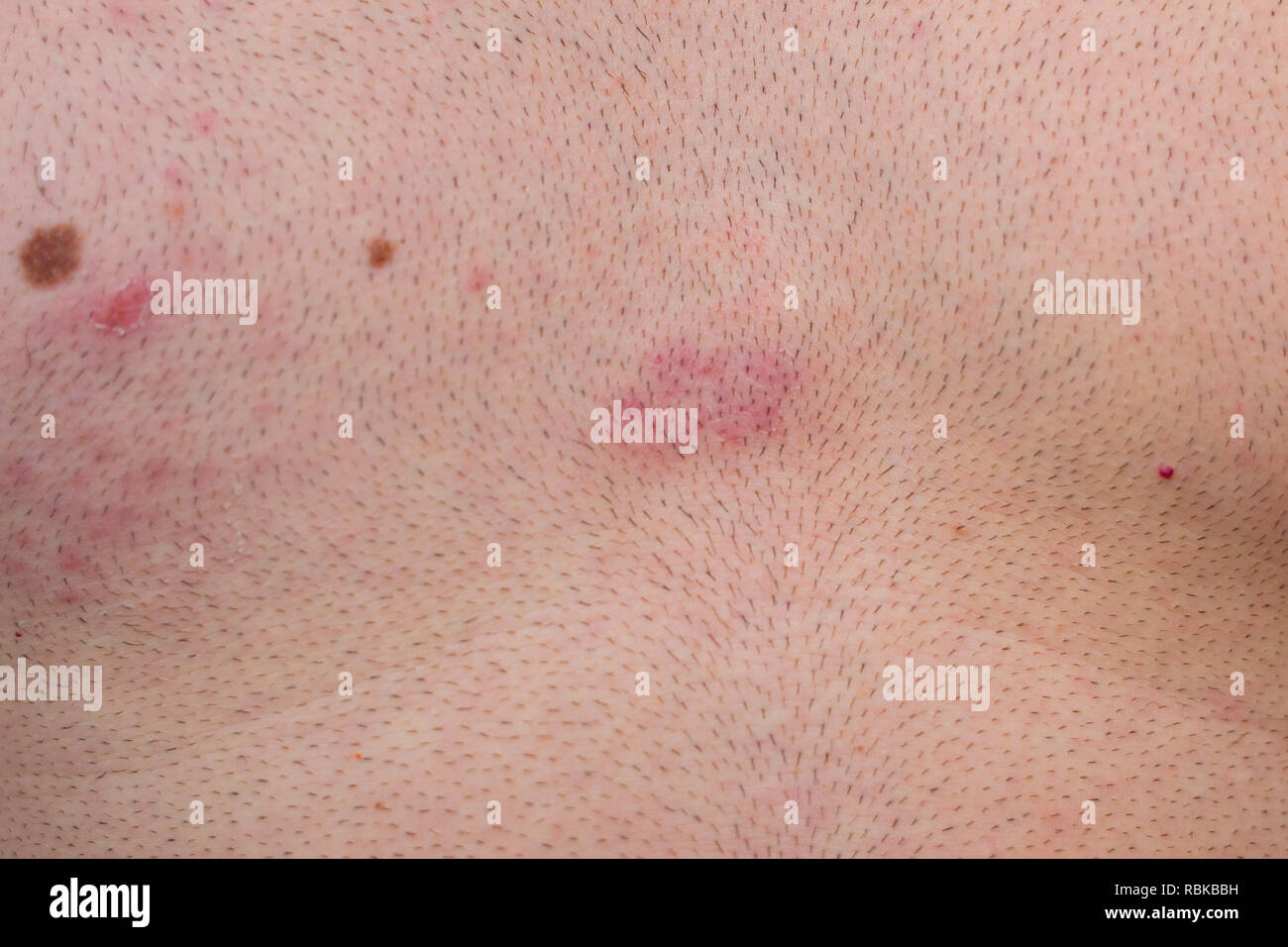 Enfermedad de culebrilla, herpes zoster, ampollas en el cuerpo, el virus  varicela-zoster, erupción en la piel Fotografía de stock - Alamy