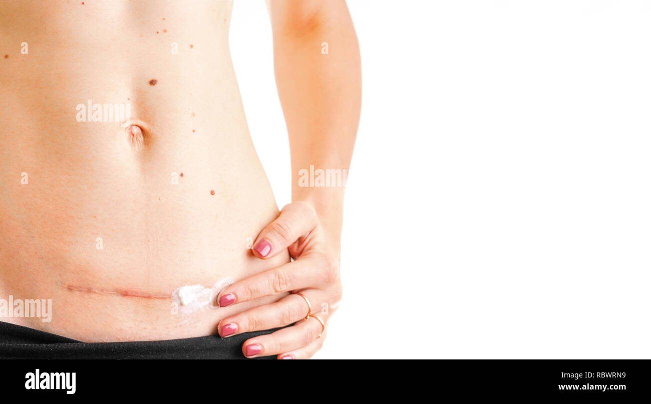 Mujer vientre con cicatriz de Cesárea c crema cicatrizante medicina fondo  blanco aislado Fotografía de stock - Alamy