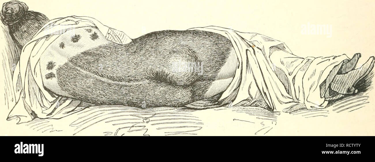 . Der Mensch. Antropología; Anatomía Humana; Fisiología. 156 3iatürlid)e itnb fünfttid^e aKipitbungen ber 5Jcenfc^engeftaIt. babiird) ueranlnfst, baji iä) bie ^nid)t nidjt ünf^v fonbern xeä)t§ auf bie ^eimb(afe (ügl frümmtc. ^ej-t, ©. 132). 9}^andjmal i[t bie Umlagerung auf bie £uut3ue, maudjmal befdjräuft auf beu 3>erbauung§fd)(aud) ober auf bie lluterleibx^orgaue. 3LN beu SSuugeu rcurbe per= mei)xte ub üerniiuberte SSappung beobad)tet. 3tni ^ergen fiubeu fid; galjlreidje t)ierl)er getjöriöe Dlii^bilbuucjeu, luelc^e fid) teilf> aU ©efcfte, tcil^ ahi ^emmuug^3bilbuugen, größten: Uil§> Foto de stock