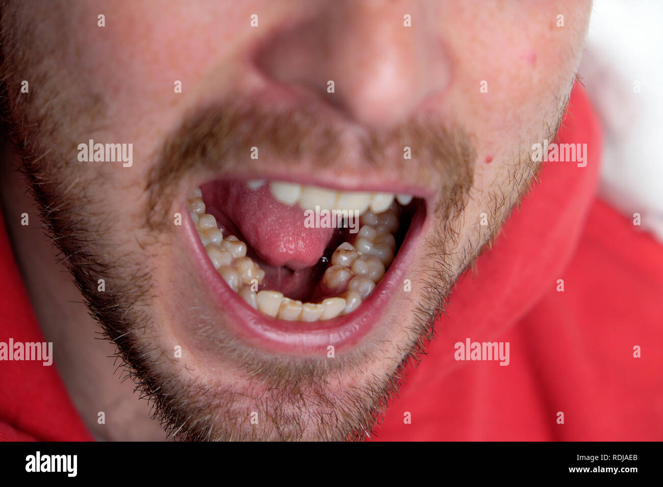 Un hombre joven con la boca abierta mostrando su juego extra de molares, premolares supernumerarios dientes premolares en Gales UK KATHY DEWITT Foto de stock