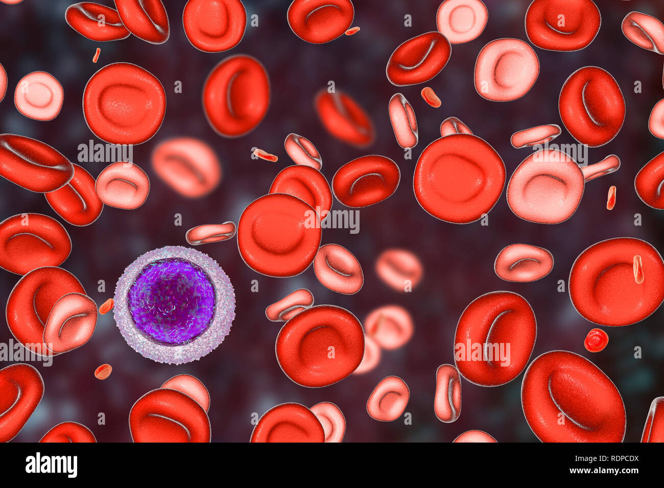 Discriminar valor Arreglo La anemia por deficiencia de hierro. Equipo ilustración mostrando la sangre  de un paciente después de hemotransfusion. Los glóbulos rojos normales son  vistos junto con hipocrómica (mancha mal) y microcítica (pequeño) de