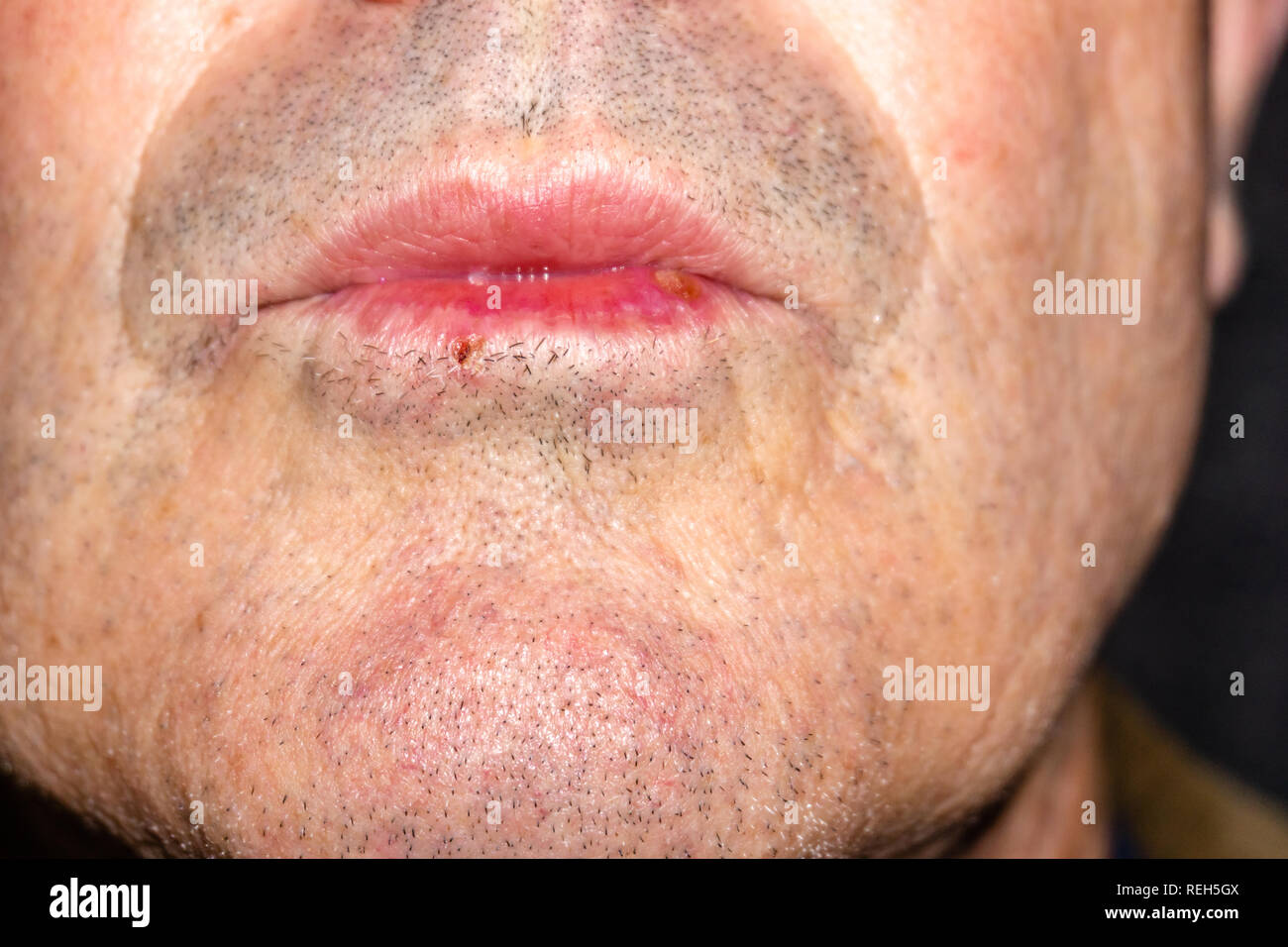 Herpes en los labios de un hombre. herpes labial, tratamiento de espacio de  copia Fotografía de stock - Alamy