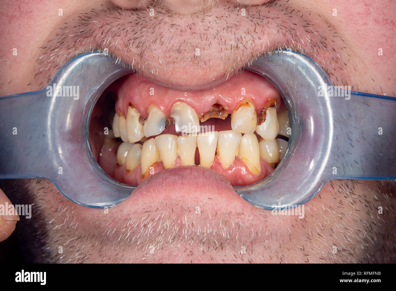Dientes podridos, caries y placa de cerca en un paciente enfermo