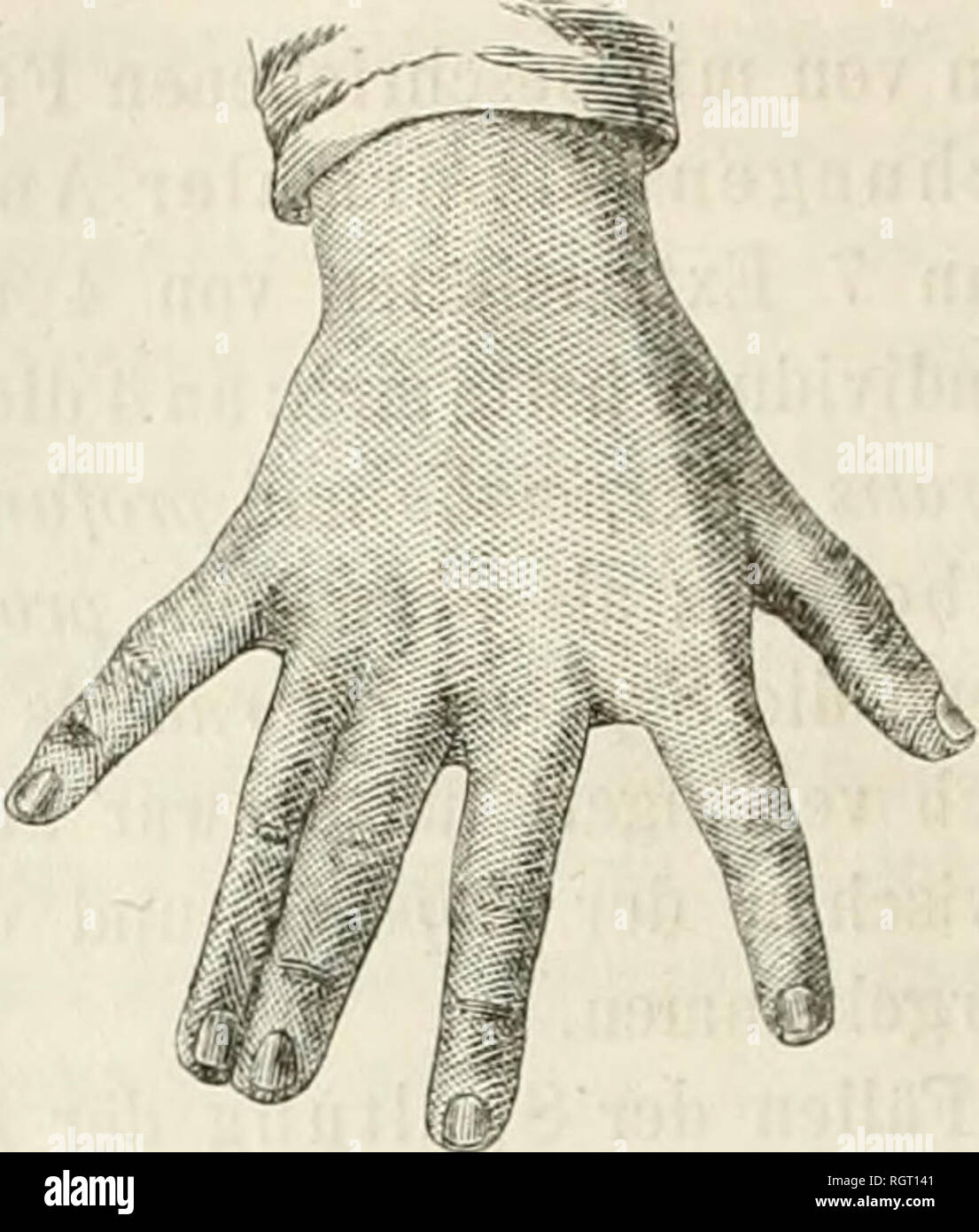 Vena superficial fotografías e imágenes de alta resolución Alamy