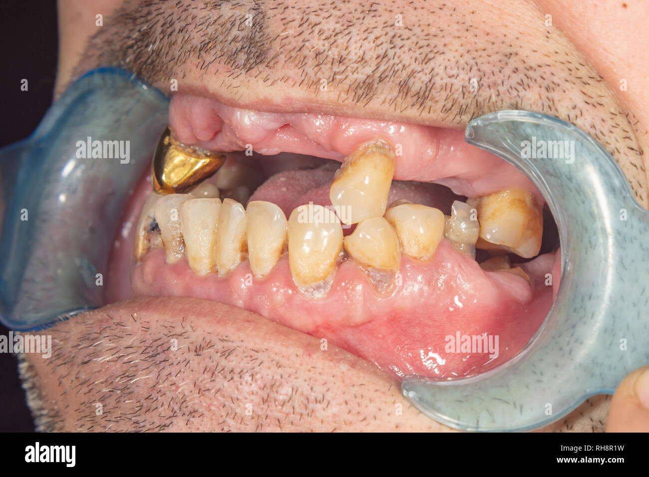 Dientes podridos fotografías e imágenes de alta resolución - Alamy